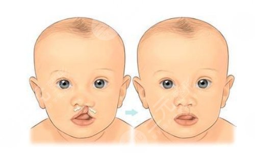 唇腭裂修復(fù)手術(shù)費(fèi)用價(jià)格影響因素