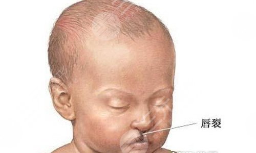 唇腭裂價(jià)格