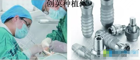 國產(chǎn)種植牙品牌及價格是多少