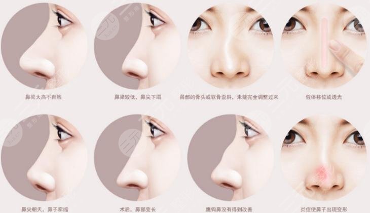 宿遷第一人民醫(yī)院整形美容科隆鼻修復(fù)相關(guān)問答科普