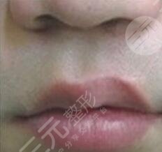 唇腭裂修復(fù)術(shù)后