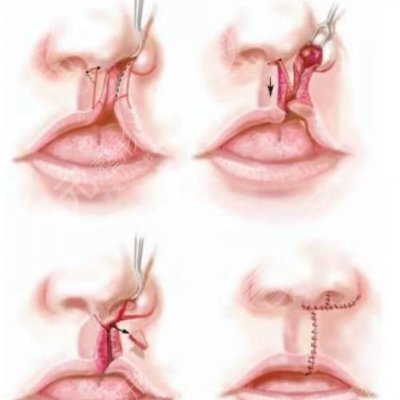 兔唇修復(fù)后的疤痕可以去掉嗎？真人兔唇矯正果：不再有異樣眼光