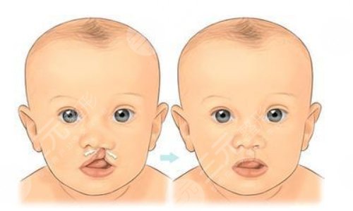 兔唇修復(fù)后的疤痕可以去掉嗎