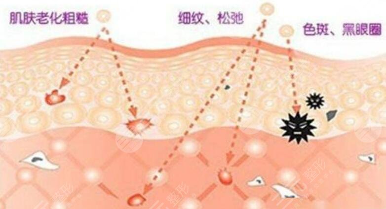 做激光除皺的注意事項