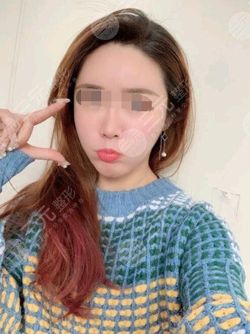 btl射頻緊膚真人案例后一個月