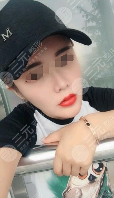 btl射頻緊膚真人案例后