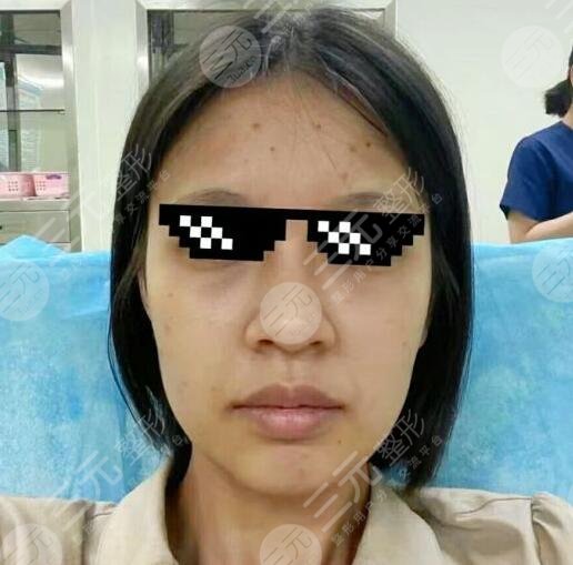 7d聚拉提體驗果圖