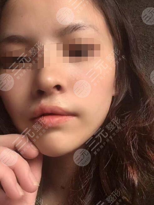 真人做兔唇修復(fù)后6個月