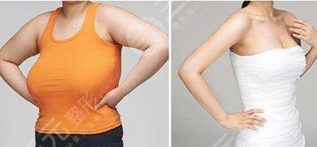 棒棒糖做縮胸手術(shù)疤痕怎么去除?