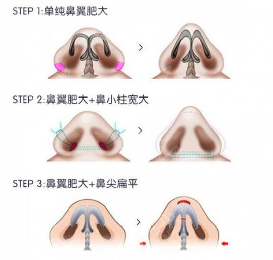 影響鼻翼縮小手術(shù)價(jià)格的因素