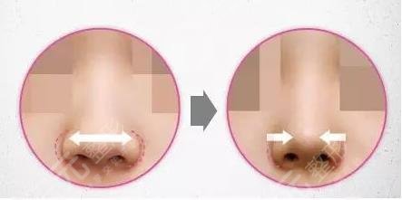 鼻翼縮小手術(shù)的mz方式