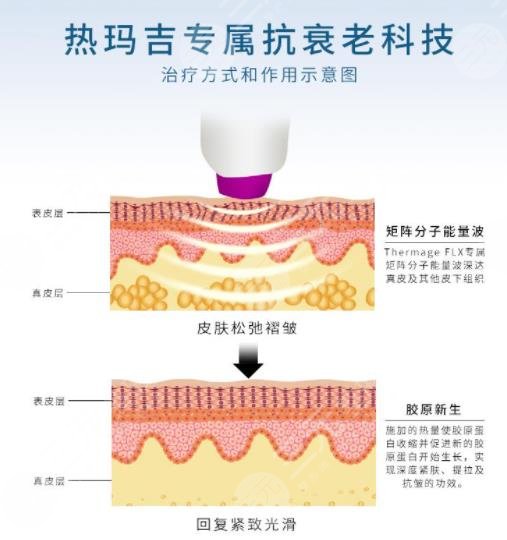 熱瑪吉相關(guān)問答科普