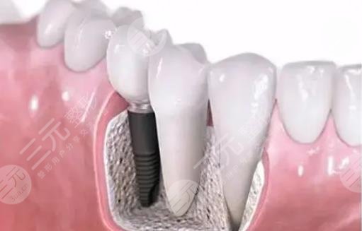 種植牙