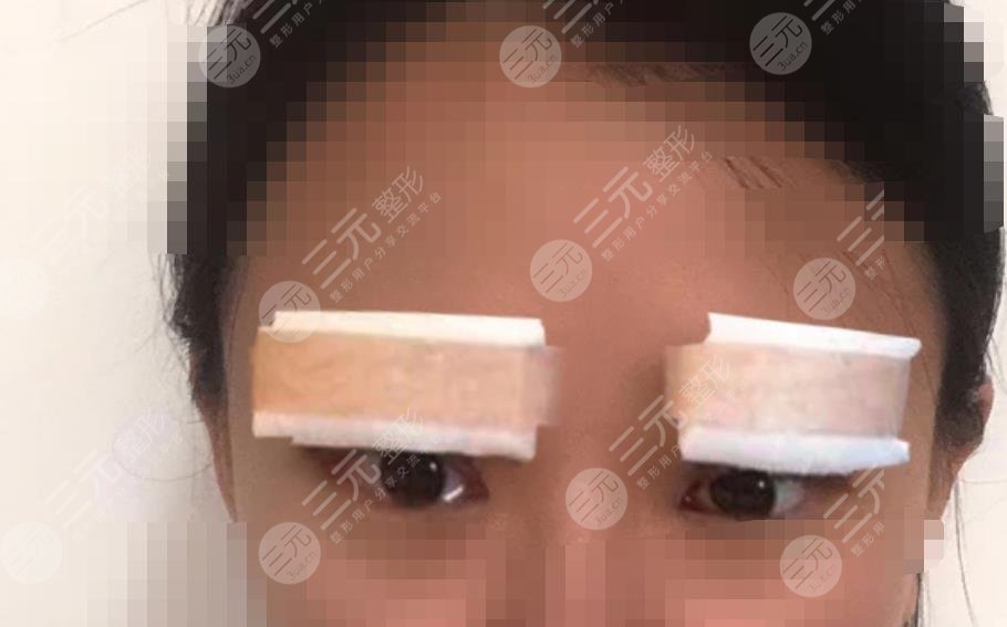 做雙眼皮修復(fù)之后