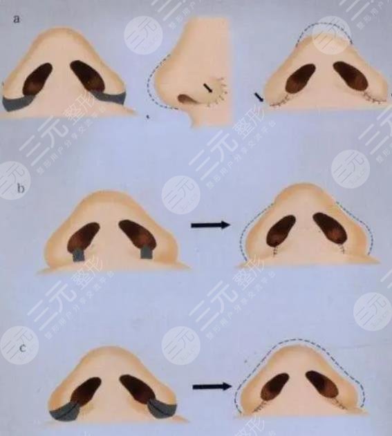 鼻翼整形原理