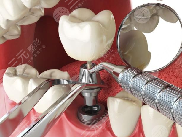 種植牙手術(shù)的原理