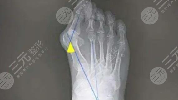 大腳骨手術(shù)