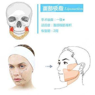 雙下巴吸脂