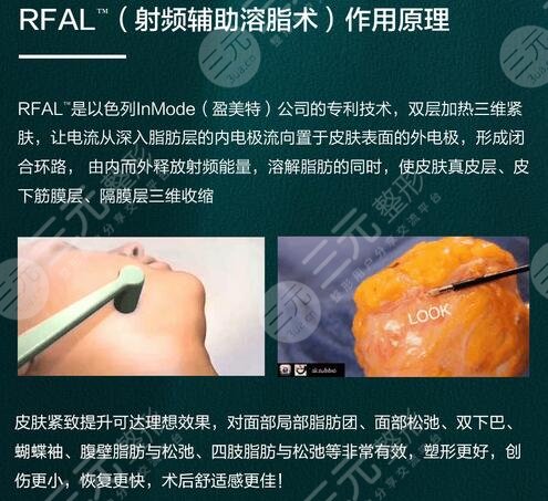 雙下巴吸脂多少錢(qián)