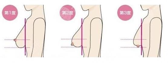 乳房提升棒棒糖手術(shù)術(shù)后怎么護(hù)理?