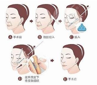中面部拉皮手術(shù)怎么做的?