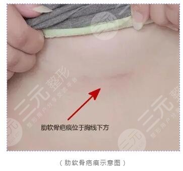 自體軟骨隆鼻術(shù)后注意事項