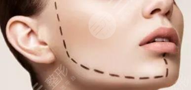 做拉皮手術(shù)的注意事項