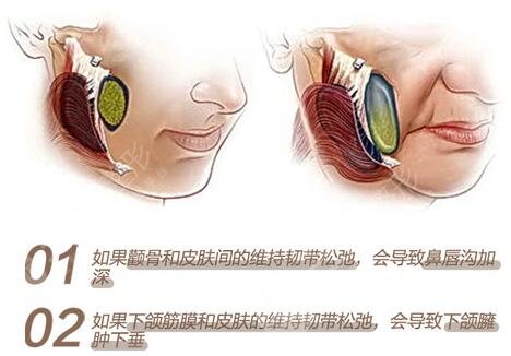 內窺鏡除皺術缺點科普！手術果到底咋樣？一文解答你的困惑，附價格~