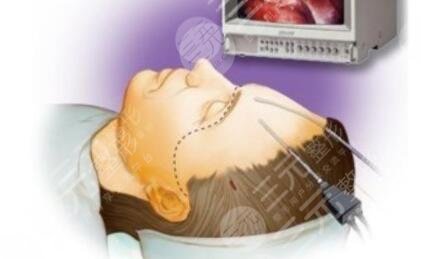 內(nèi)窺鏡拉皮是什么原理