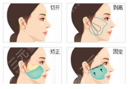 迷你小拉皮是什么原理