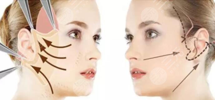 拉皮除皺手術(shù)是什么呢