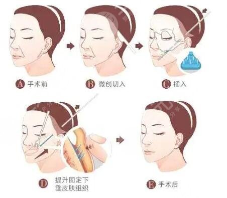 拉皮除皺手術(shù)有什么優(yōu)點