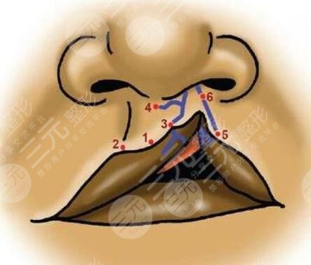 兔唇手術(shù)的費(fèi)用