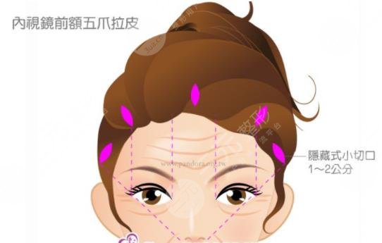 內(nèi)窺鏡拉皮手術(shù)果保持幾年？維持時間解析+手術(shù)注意事項解答