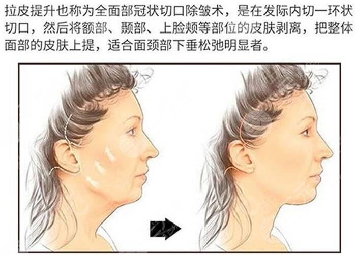 內(nèi)窺鏡除皺術(shù)