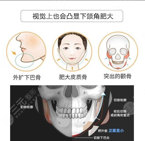 金一秀醫(yī)生解答磨骨項目科普