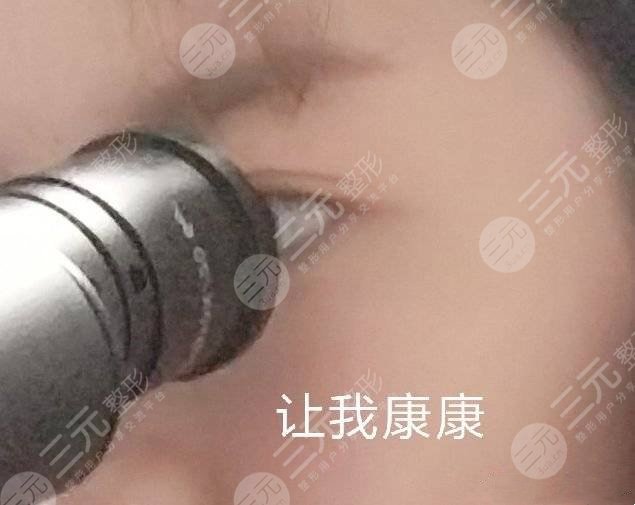 廈門海峽張宏做雙眼皮如何？