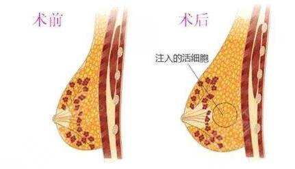 自體脂肪隆胸手術(shù)有風(fēng)險(xiǎn)嗎