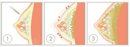 自體脂肪隆胸手術(shù)后注意事項(xiàng)有哪些