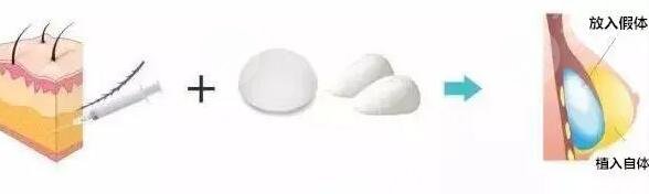 棉花糖豐胸和假體豐胸哪個(gè)好