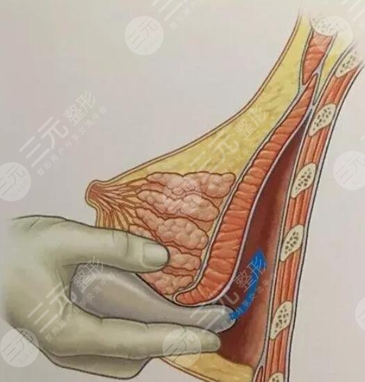 棉花糖豐胸是什么原理?