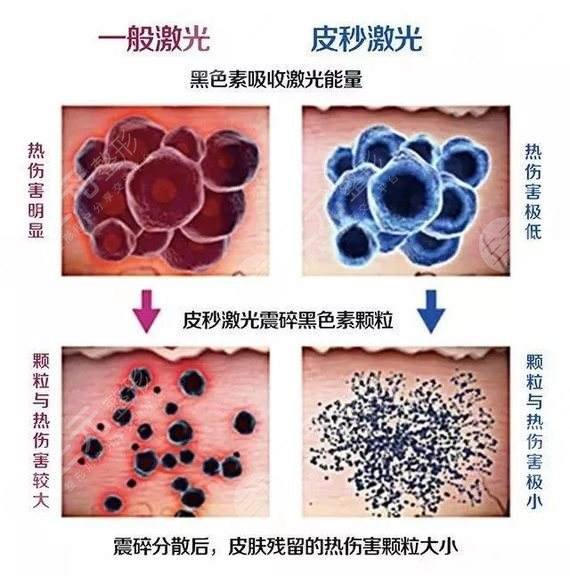 激光pm激光洗紋身