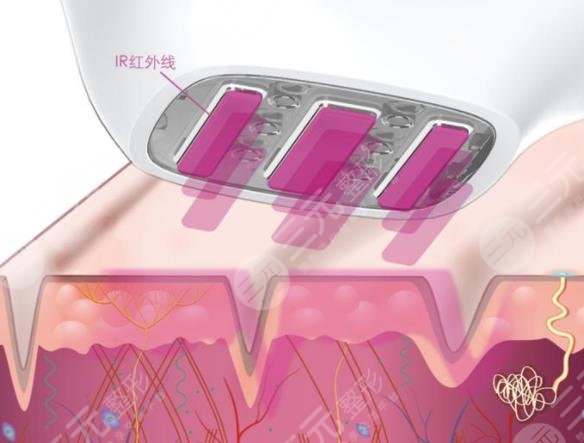 3d射頻美容維持多長時間