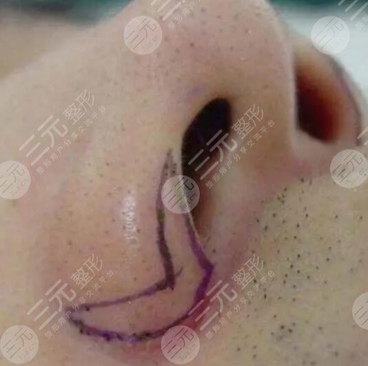 鼻翼整形術(shù)后的果怎么樣