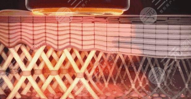 射頻除皺手術(shù)術(shù)后需要怎么護(hù)理