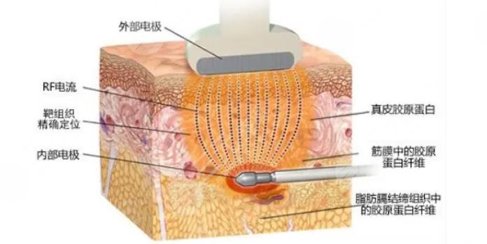 3d射頻緊膚去皺項(xiàng)目表202