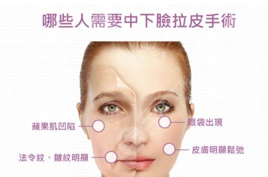 什么是內(nèi)窺鏡拉皮手術(shù)?