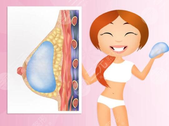 棉花糖豐胸手術的優(yōu)點