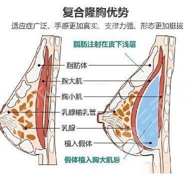 什么是復合隆胸