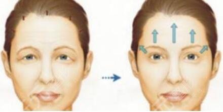 超聲提拉抗衰術(shù)后的注意事項(xiàng)